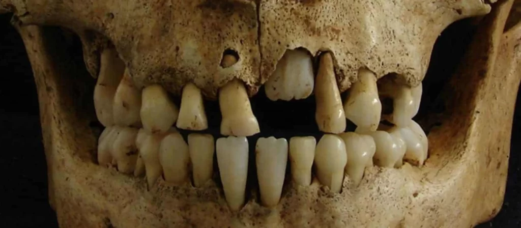 تاریخچه‌ ی ایمپلنت های دندانی